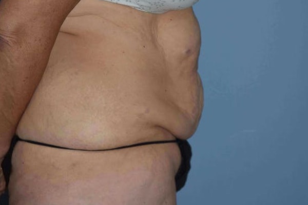 Tummy Tuck Before & After Gallery - Patient 158775 - Image 7