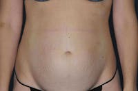 Tummy Tuck Before & After Gallery - Patient 371237 - Image 1