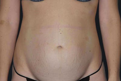 Tummy Tuck Before & After Gallery - Patient 371237 - Image 1