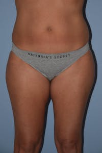 Liposuction Before & After Gallery - Patient 944610 - Image 1