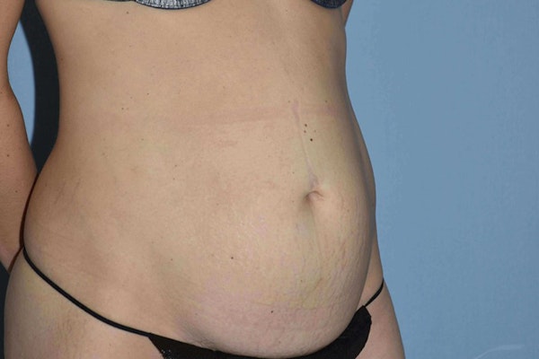 Tummy Tuck Before & After Gallery - Patient 371237 - Image 3