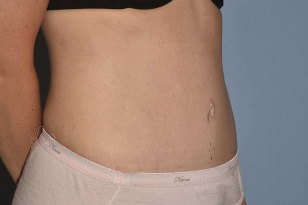 Tummy Tuck Before & After Gallery - Patient 371237 - Image 4