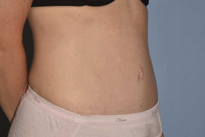 Tummy Tuck Before & After Gallery - Patient 371237 - Image 4