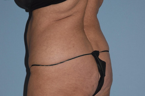 Liposuction Before & After Gallery - Patient 406480 - Image 1