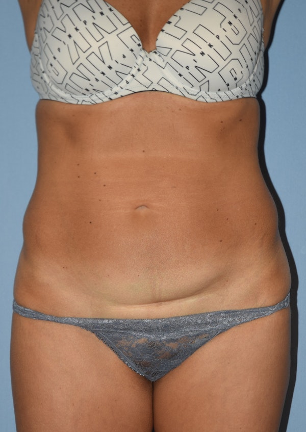 Tummy Tuck Before & After Gallery - Patient 131840 - Image 1