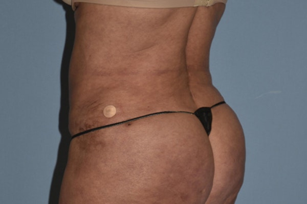 Liposuction Before & After Gallery - Patient 406480 - Image 2