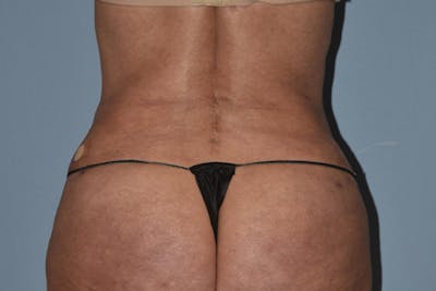 Liposuction Before & After Gallery - Patient 406480 - Image 4