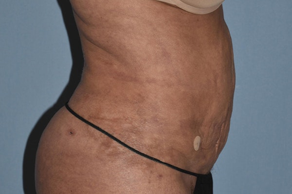 Liposuction Before & After Gallery - Patient 406480 - Image 8
