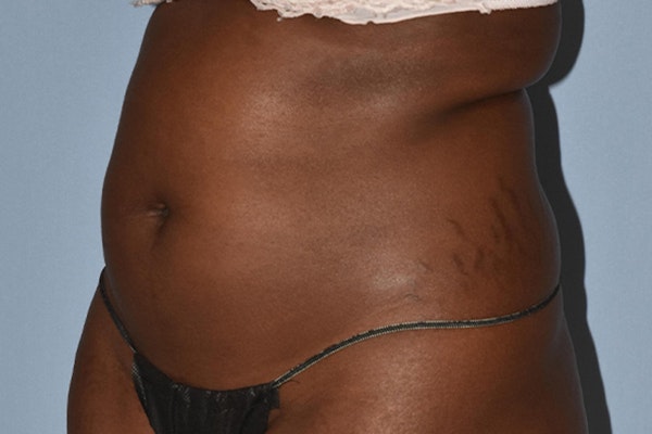 Liposuction Before & After Gallery - Patient 357120 - Image 3