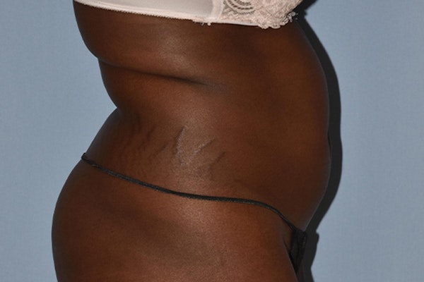 Liposuction Before & After Gallery - Patient 357120 - Image 5