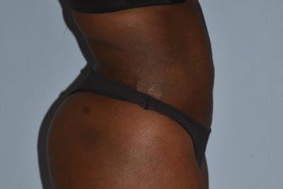 Liposuction Before & After Gallery - Patient 357120 - Image 6