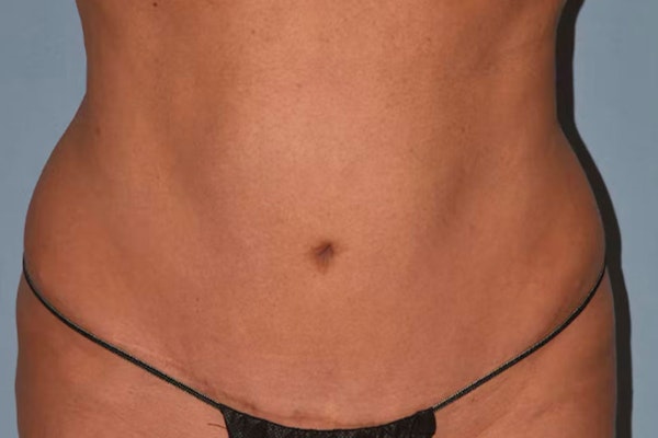 Liposuction Before & After Gallery - Patient 391239 - Image 1
