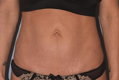 Tummy Tuck Before & After Gallery - Patient 346813 - Image 2