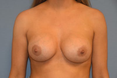 Breast Augmentation Before & After Gallery - Patient 366830 - Image 2