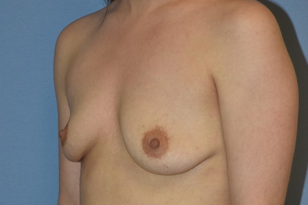 Breast Augmentation Before & After Gallery - Patient 366830 - Image 3