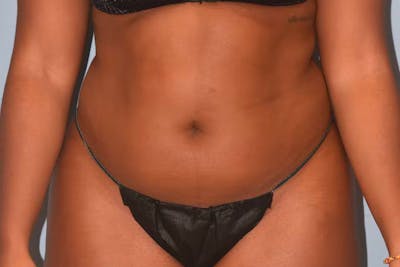 Liposuction Before & After Gallery - Patient 353614 - Image 1