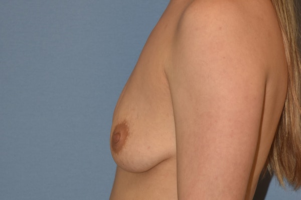 Breast Augmentation Before & After Gallery - Patient 366830 - Image 5