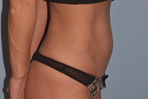 Tummy Tuck Before & After Gallery - Patient 346813 - Image 6
