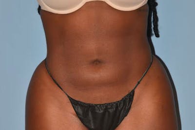 Liposuction Before & After Gallery - Patient 353614 - Image 2