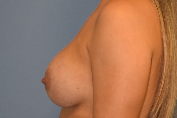 Breast Augmentation Before & After Gallery - Patient 366830 - Image 6