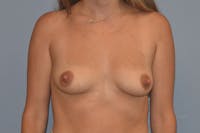Breast Augmentation Before & After Gallery - Patient 109975 - Image 1