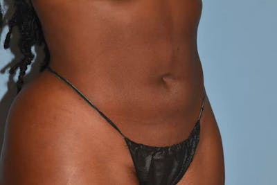 Liposuction Before & After Gallery - Patient 353614 - Image 4