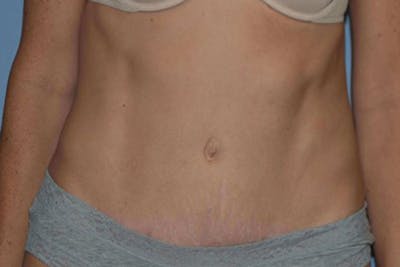 Tummy Tuck Before & After Gallery - Patient 337648 - Image 2