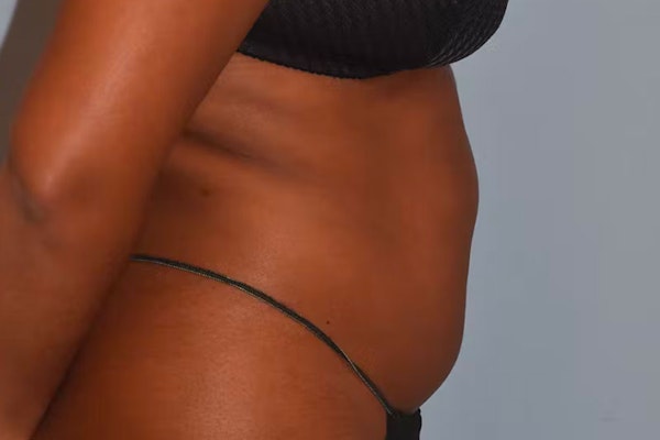 Liposuction Before & After Gallery - Patient 353614 - Image 5