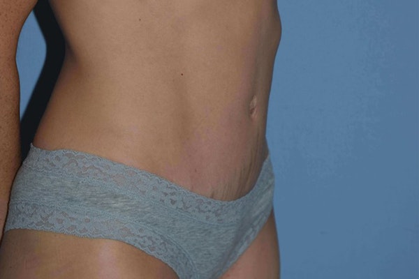 Tummy Tuck Before & After Gallery - Patient 337648 - Image 4