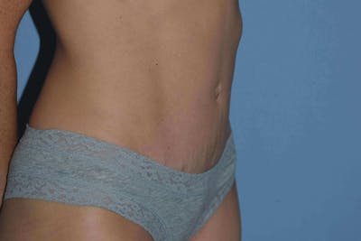 Tummy Tuck Before & After Gallery - Patient 337648 - Image 4