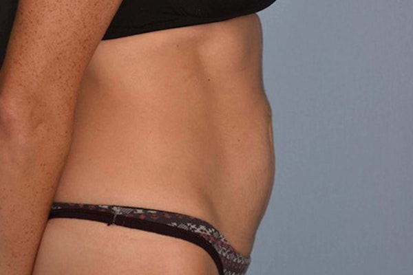 Tummy Tuck Before & After Gallery - Patient 337648 - Image 5