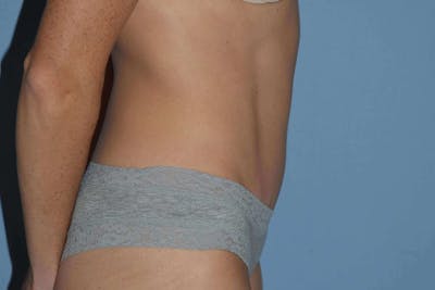 Tummy Tuck Before & After Gallery - Patient 337648 - Image 6