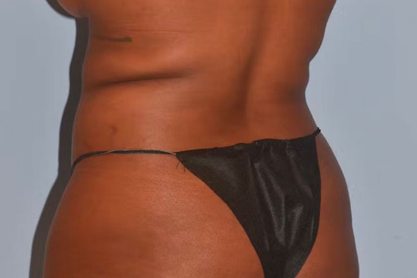 Liposuction Before & After Gallery - Patient 353614 - Image 9
