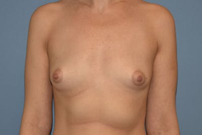 Breast Augmentation Before & After Gallery - Patient 236606 - Image 1
