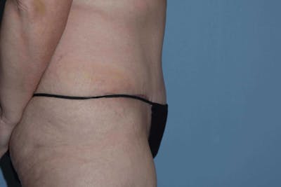 Tummy Tuck Before & After Gallery - Patient 655290 - Image 6