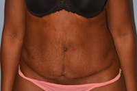 Tummy Tuck Before & After Gallery - Patient 363538 - Image 1