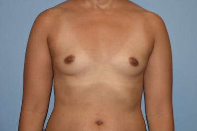 Breast Augmentation Before & After Gallery - Patient 227110 - Image 1