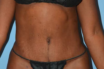 Tummy Tuck Before & After Gallery - Patient 363538 - Image 2