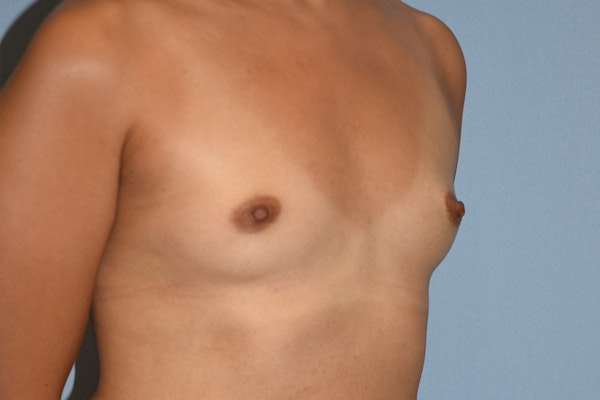 Breast Augmentation Before & After Gallery - Patient 227110 - Image 3