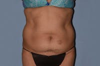 Tummy Tuck Before & After Gallery - Patient 249231 - Image 1