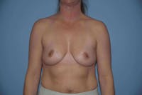 Breast Augmentation Before & After Gallery - Patient 145865 - Image 1