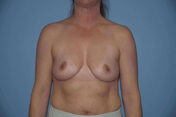Breast Augmentation Before & After Gallery - Patient 145865 - Image 1