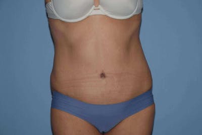 Tummy Tuck Before & After Gallery - Patient 249231 - Image 2