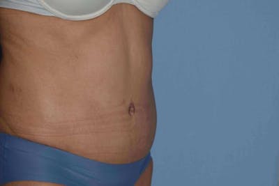 Tummy Tuck Before & After Gallery - Patient 249231 - Image 4