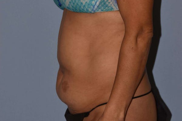 Tummy Tuck Before & After Gallery - Patient 249231 - Image 5