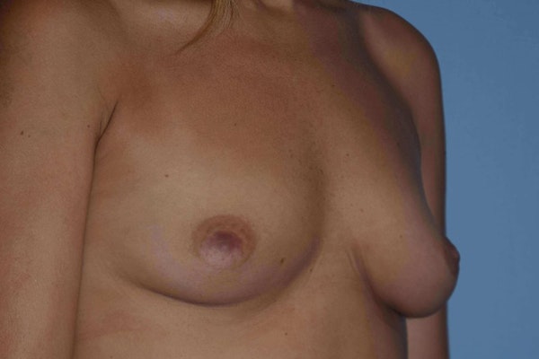 Breast Augmentation Before & After Gallery - Patient 380938 - Image 3