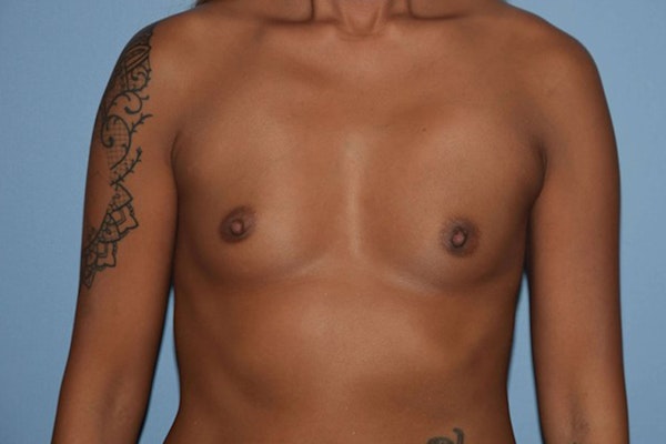 Breast Augmentation Before & After Gallery - Patient 588886 - Image 1