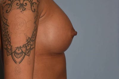 Breast Augmentation Before & After Gallery - Patient 588886 - Image 6