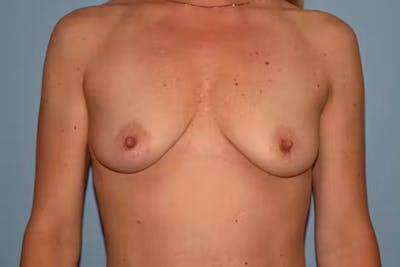 Breast Augmentation Before & After Gallery - Patient 194649 - Image 1
