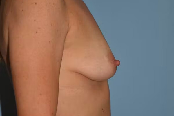 Breast Augmentation Before & After Gallery - Patient 194649 - Image 5